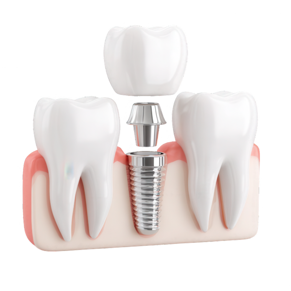 Transform Your Smile with St Albans' Trusted Implant Clinic at Happy Family Dental, St Albans